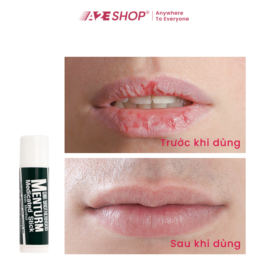 Omi Menturm Moisturizing Lip Balm (Prevents Dry & Chapped Lips)